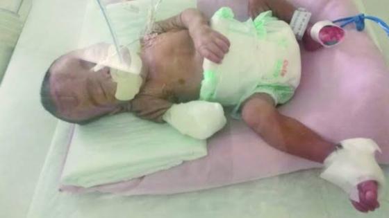 طفل سعودي يعاني من تشوهات عظمية وتدخل فريق طبي بمنع بتر ساق هذا الطفل